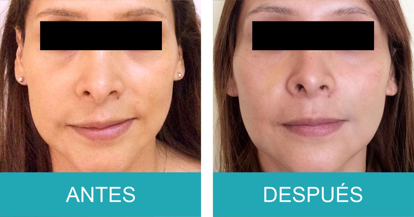 Antes y Despues Sculptra