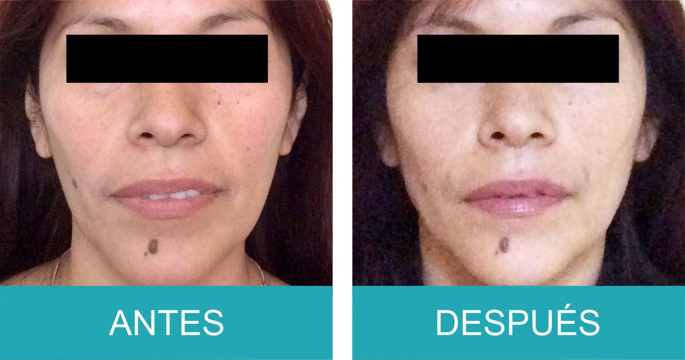 Antes y Despues Sculptra